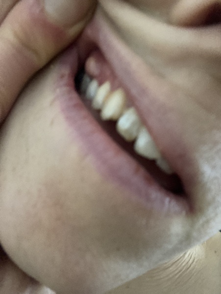 Any clue what this is in my mouth? Should I see dr or dentist or neither?!