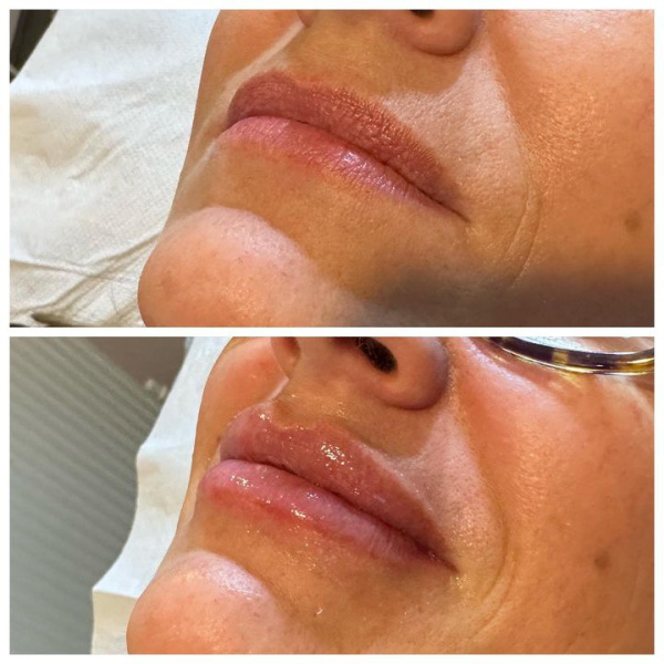 First time for fillers - any tips?