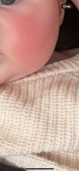 Eczema or allergy