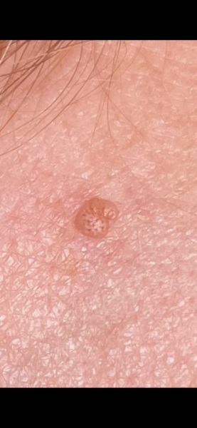 Any dermatologists around - is this a melanoma?