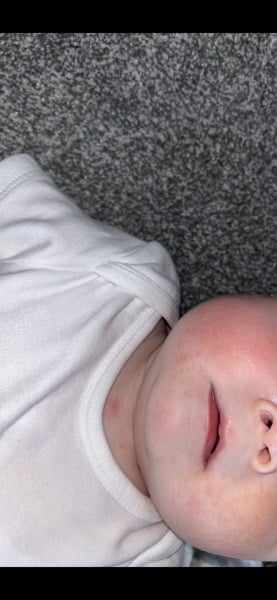 Eczema or allergy
