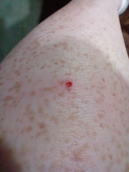 If you ignored an ingrown hair for years, would it look like this?