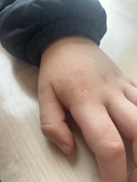 What does this rash look like on my 5 year old’s skin?