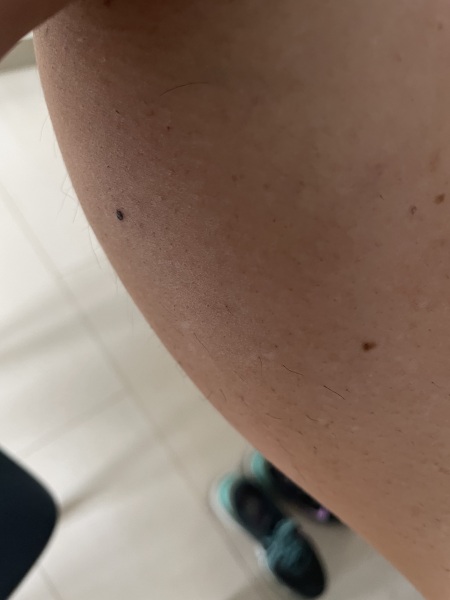 Small dark mole - anyone had?