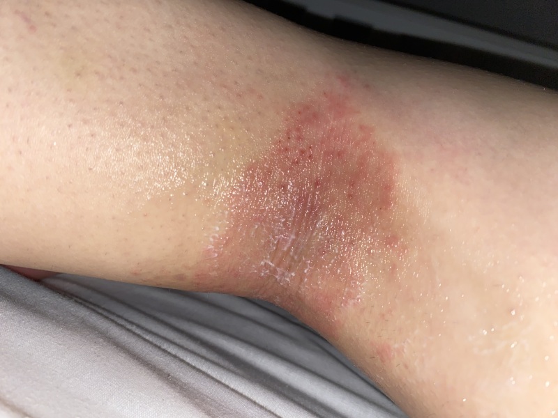 Anyone else with eczema this bad
