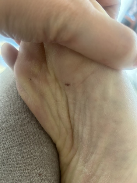 Melanoma?