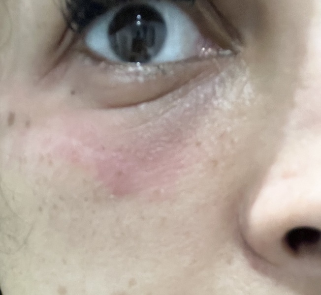 Hives under eyes -Fexafenadine or steroid cream?