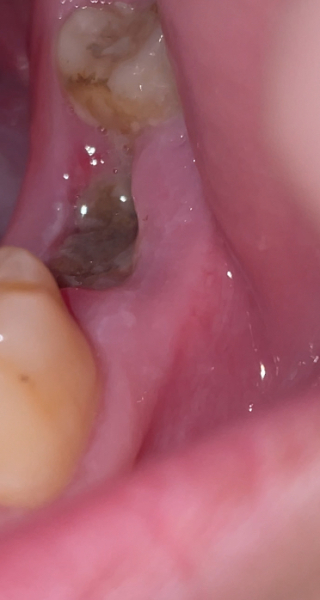 Tooth extraction after care advice!
