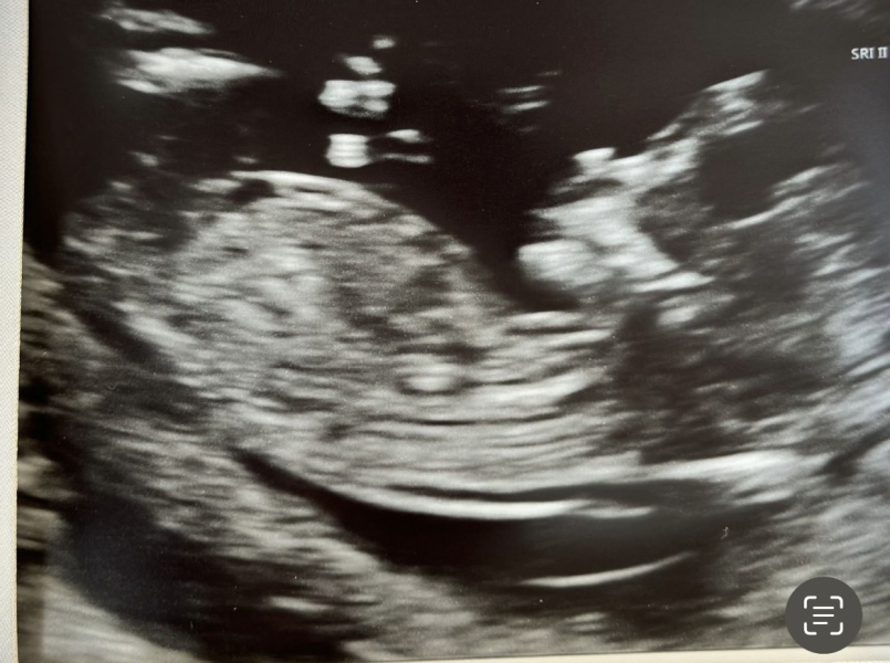 Do you want me to guess the sex? 12 week scans.