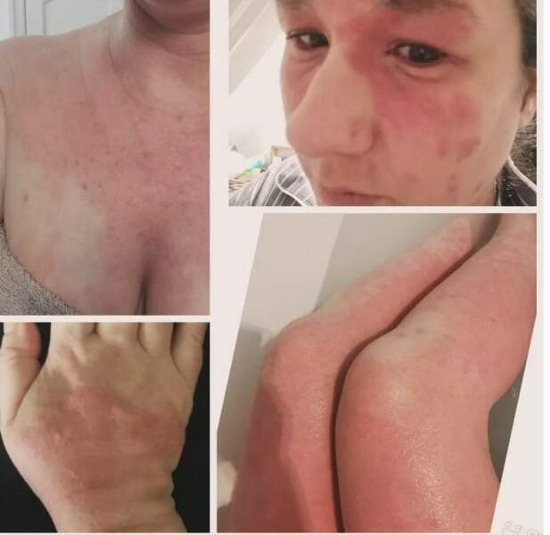 Hives under eyes -Fexafenadine or steroid cream?