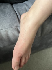 Rash - 8 year old