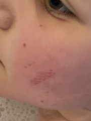 Bruise on kids face