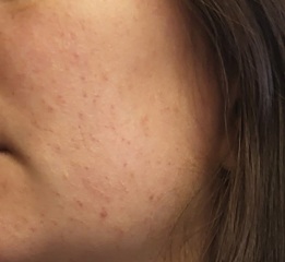 Rash on face - not there this morning - 25 weeks pregnant