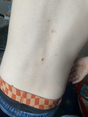 Could this have been chicken pox?