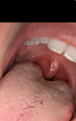 Tonsillitis or quinsy??? Help