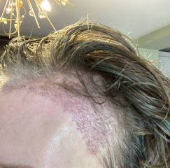 I’ve just had a hair transplant AMA