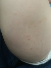Spots on my two children