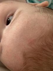 is this just baby acne/infantile acne?