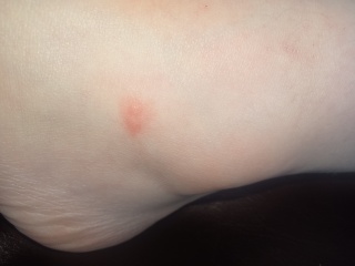 Is this chickenpox?
