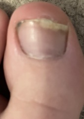 Warning - toenail photo