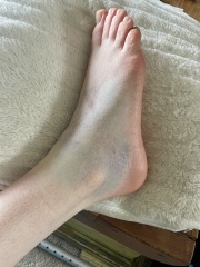 Can the Xray be wrong?!