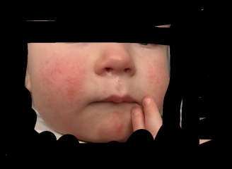 15 month old and sudden pimply rash on face