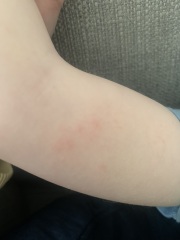 Spots on my two children