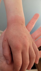 Does this look like scabies?