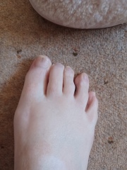 Worrying mark on toe