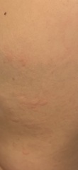 Hives every night (pic)