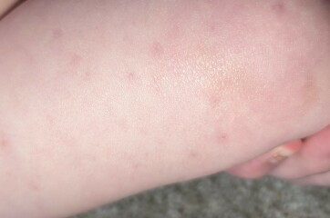 Non fading rash 10 month old - no fever/illness