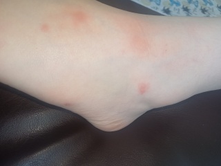 Is this chickenpox?