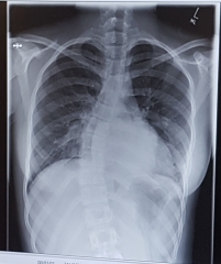 Adolescent Scoliosis...so worried!