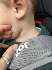 Could this be chicken pox?