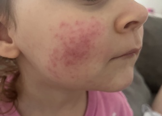 Does anyone know what this rash is?