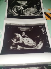 1:90 Chance My Child Could Have Downsydrome.
