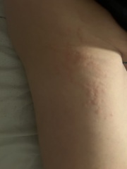 Hives every night (pic)