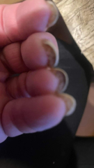 Allergic to gel nails - advice please