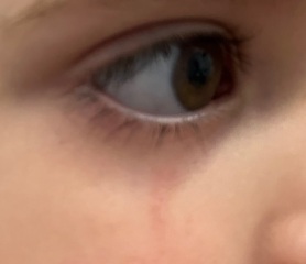 Potential scar under the eye