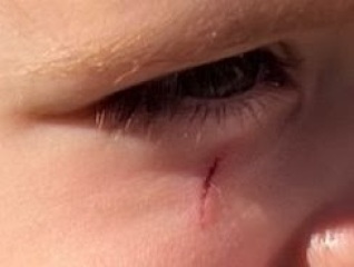 Potential scar under the eye