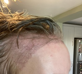 I’ve just had a hair transplant AMA