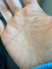 Psoriasis or eczema?