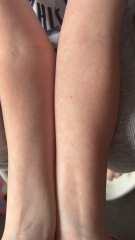 Help me figure out this rash…