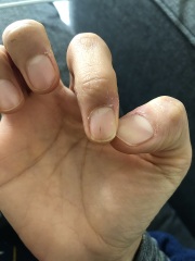 Vertical line on my fingernail