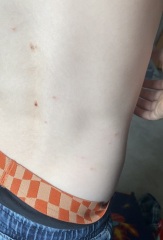 Could this have been chicken pox?