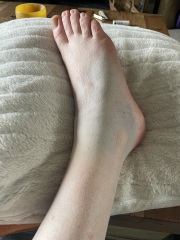 Can the Xray be wrong?!