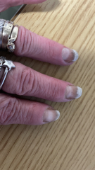 Allergic to gel nails - advice please
