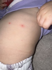 Spots on child