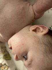 is this just baby acne/infantile acne?