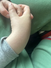 What does this rash look like on my 5 year old’s skin?